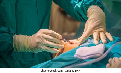 Close Up Photo Of Surgeon 's Hand During Hold The Scalpel And Made Incision On The Patient 's Skin Under The Good Light From Surgical Lamp. Picture In Blue Tone With Copy Space. Medical Concept. 