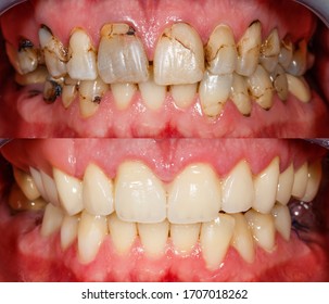 Nahaufnahme der Zähne vor und nach der Behandlung