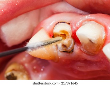 Close up photo of the teeth rehabilitation