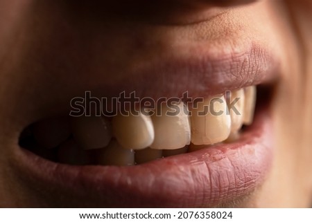 Close up photo of a woman with the cracked teeth. Teeth care concept.