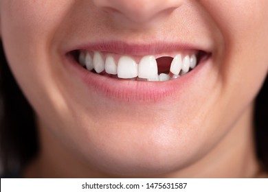 Close Up Photo Of Young Woman With Missing Tooth