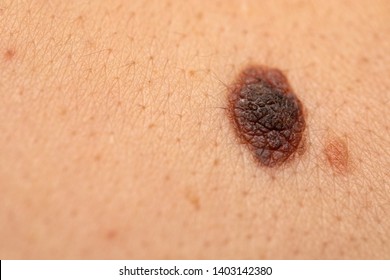 Close Up Picture Of Dangerous Brown Nevus On Human Skin - Melanoma