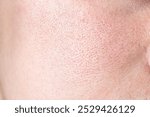 Close up picture of skin texture with enlarged pores. Face skin care concept. Problem skin treatment concept.