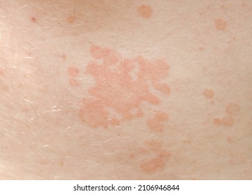 Close Portion Human Skin Rush Dermatology Stock Photo 2106946844 ...