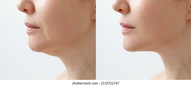 A close portrait of an aged woman before and after facial rejuvenation procedure. Correction of the chin shape liposuction of the neck. The result of the procedure in the clinic of aesthetic medicine. - Shutterstock ID 2119721747
