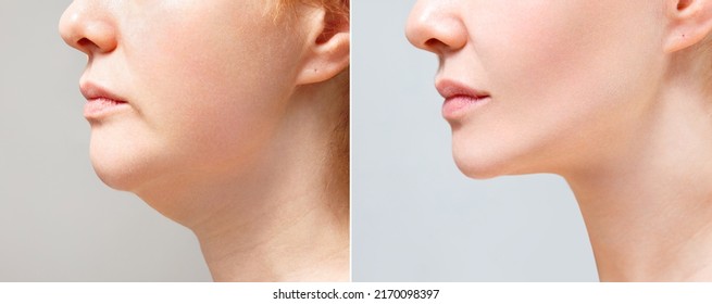 A close portrait of an aged woman before and after facial rejuvenation procedure. Correction of the chin shape liposuction of the neck. The result of the procedure in the clinic of aesthetic medicine. - Shutterstock ID 2170098397