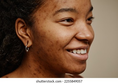 Close up portrait of ethnic young woman with acne scars on face smiling against neutral beige background, real beauty