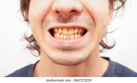 Close up portrait smile teeth man. yellow ugly teeth from smoking, alcohol, disease. Crooked dirty isolated