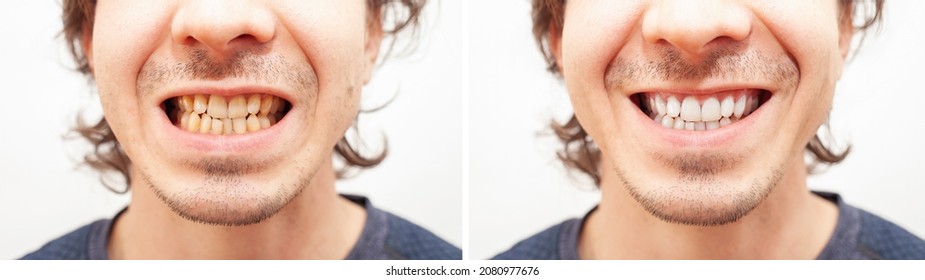 Close up portrait smile teeth man. Before and after teeth whitening, alignment, braces banner
