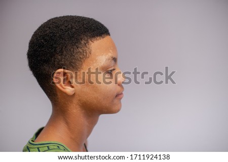 Close up portrait of teenager with skin condition