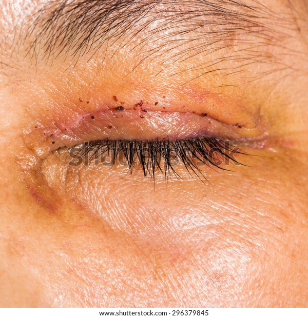 Close Post Blepharoplasty During Eye Examination Stock Photo (Edit Now ...