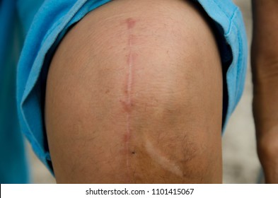 Close Up - Post Surgery Scars After Knee Reconstruction Surgery