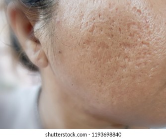 Close up of problematic skin with deep acne scars on cheek women pigmentation.