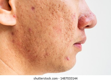 Close Up Of Problematic Skin With Deep Acne Scars On Cheek Men Pigmentation.