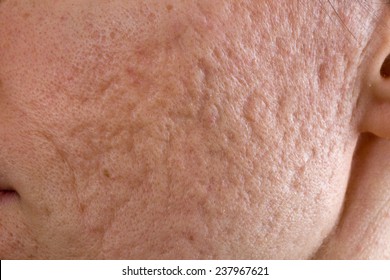 Close Up Of Problematic Skin With Deep Acne Scars On Cheek