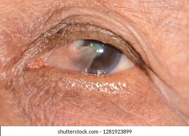 Pterygium What is