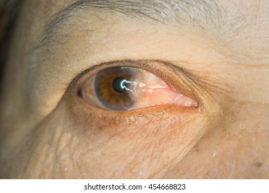 Close Pterygium During Eye Examination Stock Photo 454668823 | Shutterstock