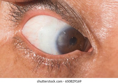 Pterygium Stock Images, Royalty-Free Images & Vectors | Shutterstock