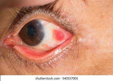 Close Pyogenic Granuloma During Eye Examination Stock Photo Edit Now 540557005