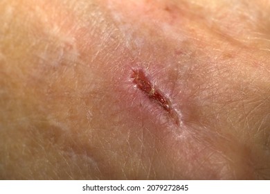 Close Up Of A Red Wound Scab Injury On The Adult Hand. Lesion Forming Wrinkle Makes Itchy And Scratch Change To Scar And Take A Long Time To Heal, Healthcare Concept