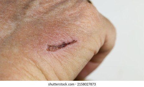 Close Up Of A Red Wound Scab Injury On The Adult Caucasian Hand. Lesion Forming Wrinkle Makes Itchy And Scratch Change To Scar And Take A Long Time To Heal, Healthcare Concept