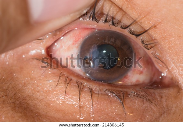 photo-de-stock-close-ruptured-globe-during-eye-examination-214806145