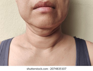 Close Up Sagging And Layered Under The Neck, Wrinkle Skin Problem Of Woman.