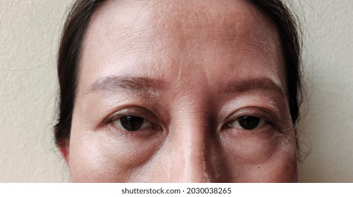 Close Up Sagging Skin Under The Eyes Of Woman, Skin Problems.