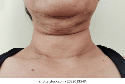 close up the sagging skin under the neck, fat layer under the chin, problem wrinkle of woman.