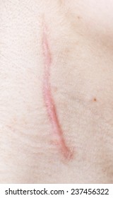 Close Up Of Scar On Human Skin