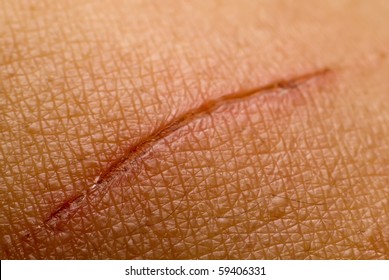 Close Up Scar On Skin