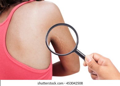 Close Up Of Scratch Mark  Wrinkle Of Armpit