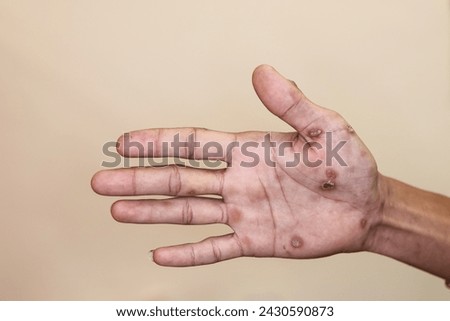 Close up of Secondary stage syphilis sores (lesions) on the palms of the hand. Referred to as 