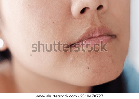 close up in selective focus of a chin with large amount of blackheads and dilated pores. Blemishes of oily and combination skin. Rough face skin with blackheads in relief.