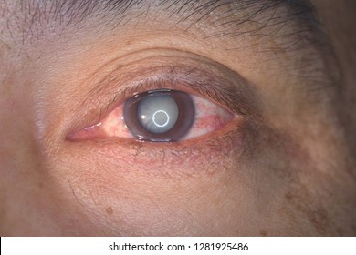 Close Up Of The Senile Cataract During Eye Examination, Mature Cataract, Neuclear Sclerosis Cataract.