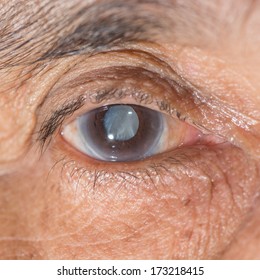 Close Up Of The Senile Cataract During Eye Examination.