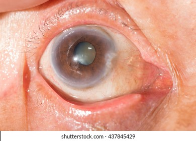 Close Up Of The Senile Cataract During Eye Examination, Senile Cataract, Mature Cataract, Neuclear Sclerosis Cataract.