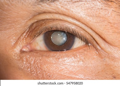 Close Up Of The Senile Cataract During Eye Examination, Mature Cataract, Neuclear Sclerosis Cataract.