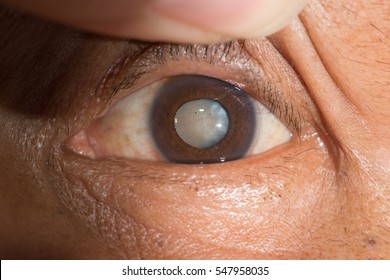 Close Up Of The Senile Cataract During Eye Examination, Mature Cataract, Neuclear Sclerosis Cataract.