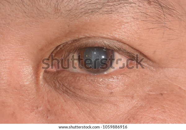 close up of the senile\
cataract during eye examination, mature cataract, neuclear\
sclerosis cataract.