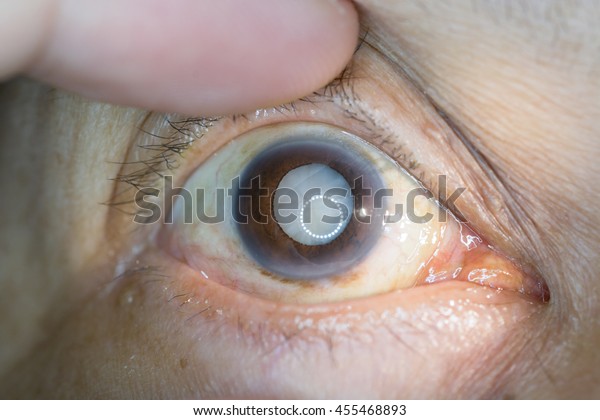 眼検査中の老人性白内障の接写 老人性白内障 成熟白内障 核硬化症白内障の接写 の写真素材 今すぐ編集