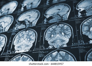 Close Up Series Of A CT Scan With Human Head On It. X-ray Medicine Concept