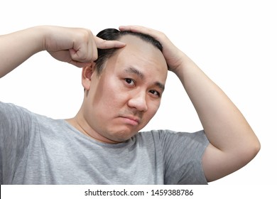 Close up of serious Asian bald man alopecia pointing his head isolated on white background. Human hair loss solution concept.