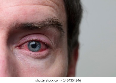 Close up of a severe bloodshot eye. Blepharitis, Conjunctivitis condition