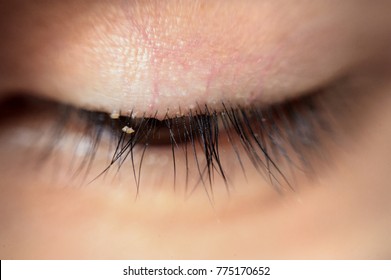 Close Up Severe Conjunctivitis From Eyelash Mites