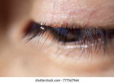 Close Up Severe Conjunctivitis From Eyelash Mites