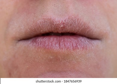 Close Up Of Severely Dry Female Lips