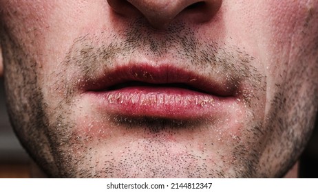 Close Severely Dry Lips Peeling Lips Stock Photo 2144812347 | Shutterstock