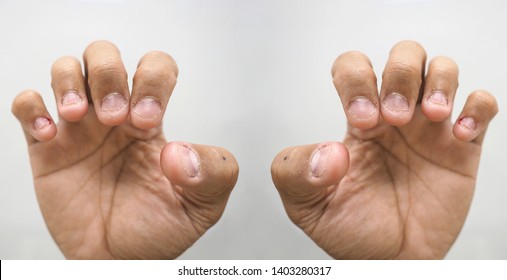 Close Up Shot Of Bad Behavior Or Habit Of Biting Nails. Refer As Stress, Anxiety, Worry And Health Issue. All Fingernails Are Bitten And Pinky Nail Is Bleeding