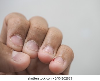 Close Up Shot Of Bad Behavior Or Habit Of Biting Nails. Refer As Stress, Anxiety, Worry And Health Issue. All Fingernails Are Bitten And Pinky Nail Is Bleeding